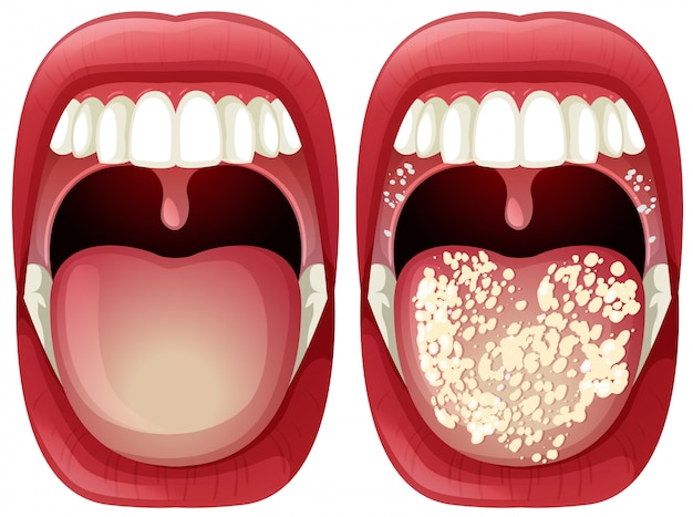 Vector vector of healthy and virus mouth