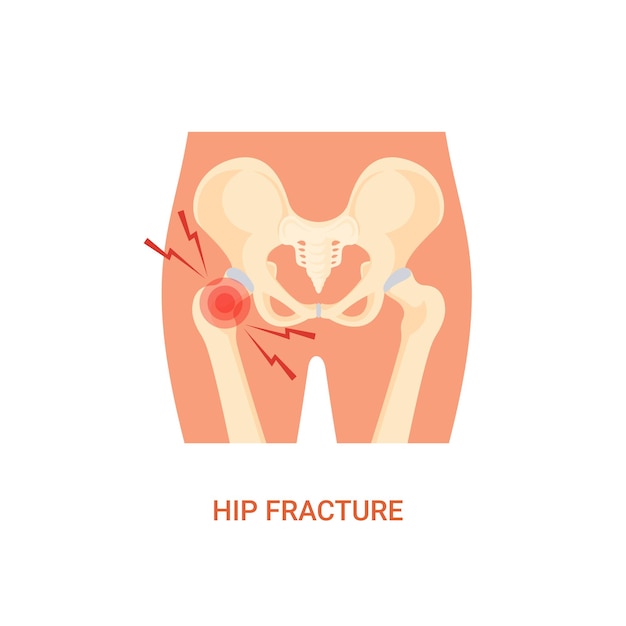 Vector of Human Hip Fracture Diagnosis