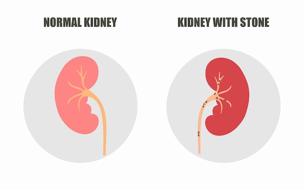 Vector illustration of Healthy kidney and kidney with stones