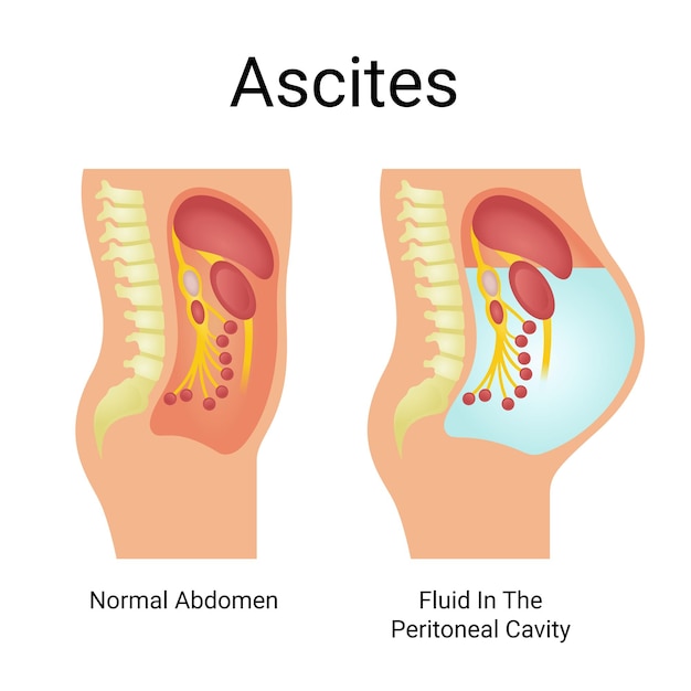 vector illustration of normal abdominal ascites and fluid in peritoneal cavity