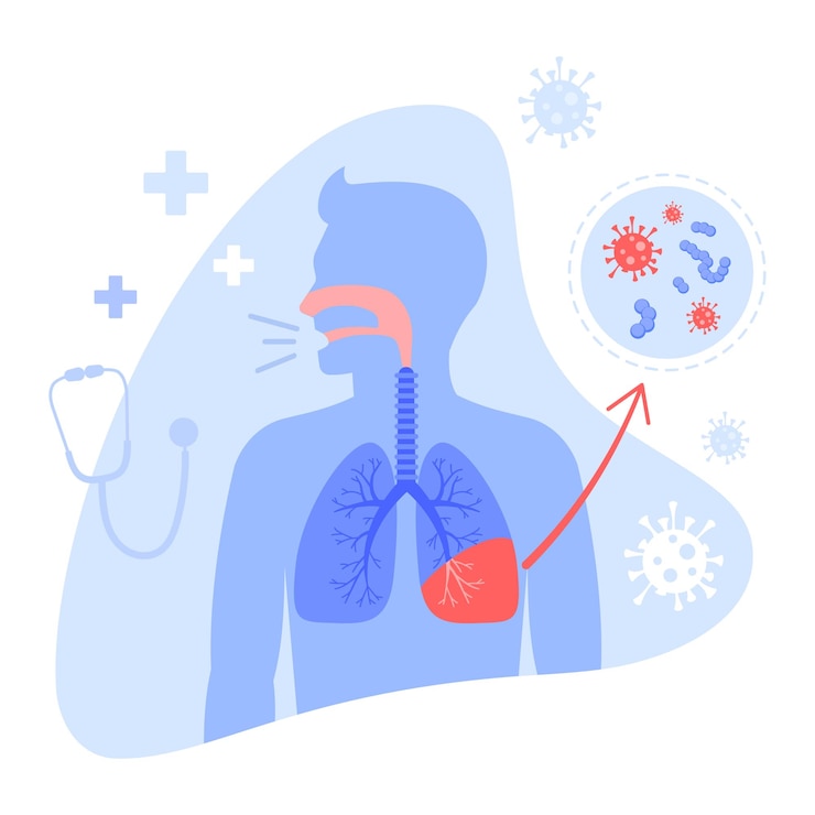 Vector vector illustration of pneumonia cartoon scene with guy who got pneumonia of the lungs and took an xray and viruses fly around him on white background