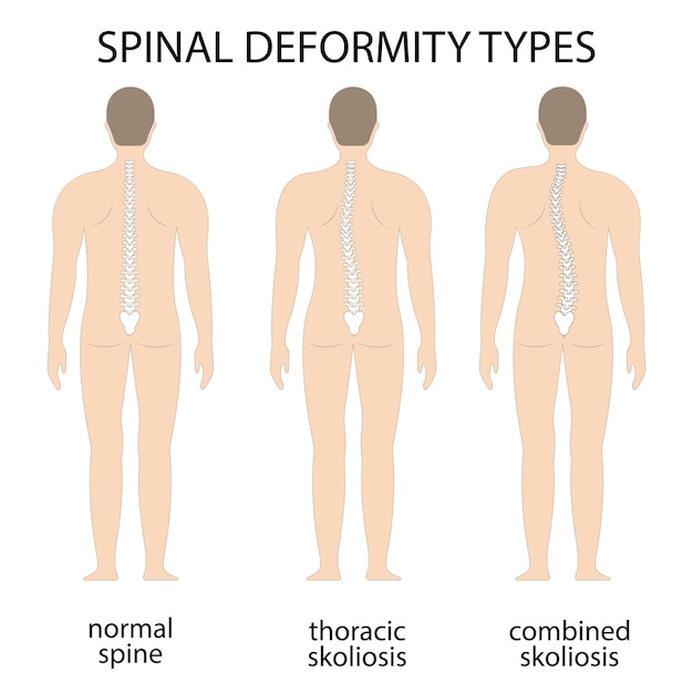 Vector vector illustration of spinal deformity kyphosis lordosis and scoliosis spine infographic body p