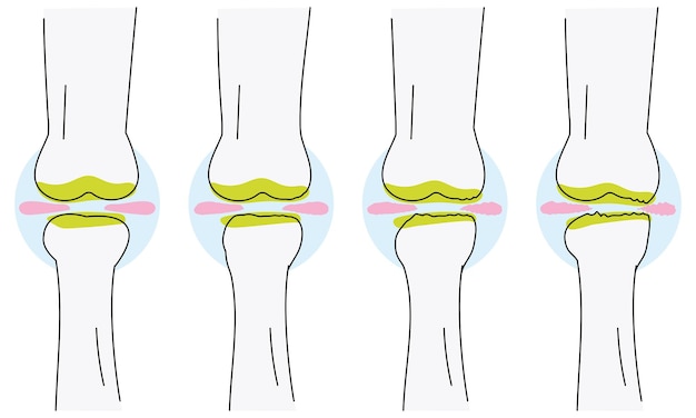 Vector vector illustrations with osteoarthritis of the knee will wear out the meniscus