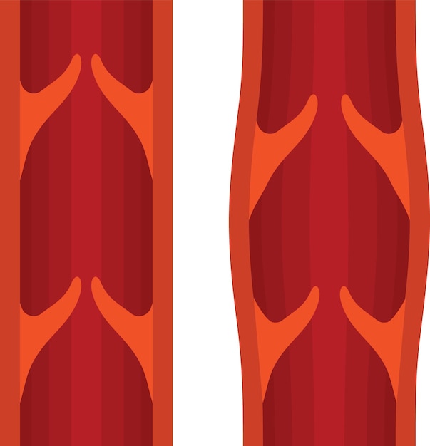 Vector Image Of Normal And Varicose Veins Isolated On Transparent Background