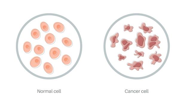 ベクトル 細胞構造のベクトル分離イラスト：正常と癌。ポスター、教育、科学、医療用の医療図。がんのアイコンまたはロゴ。