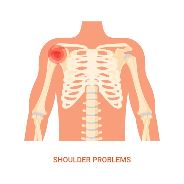 肩の問題を伴う人間の姿勢のベクトル