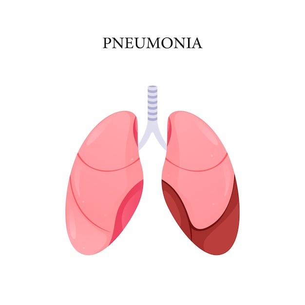 Vector pneumonia disease, illustration design for medical