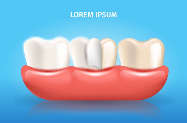 Poster dentale di vettore realistico di strato di impiallacciatura