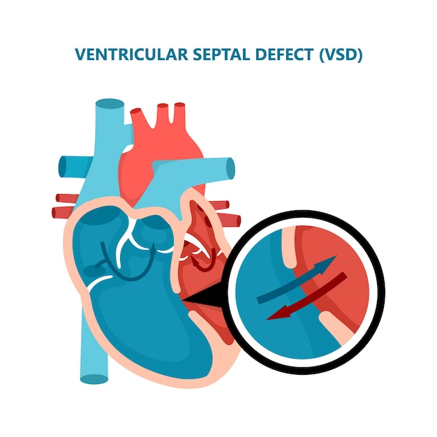 Difetto del setto ventricolare vsd sezione trasversale delle malattie del muscolo cardiaco umano