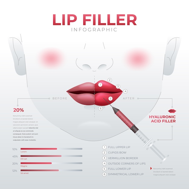 Verloop lipvuller infographic