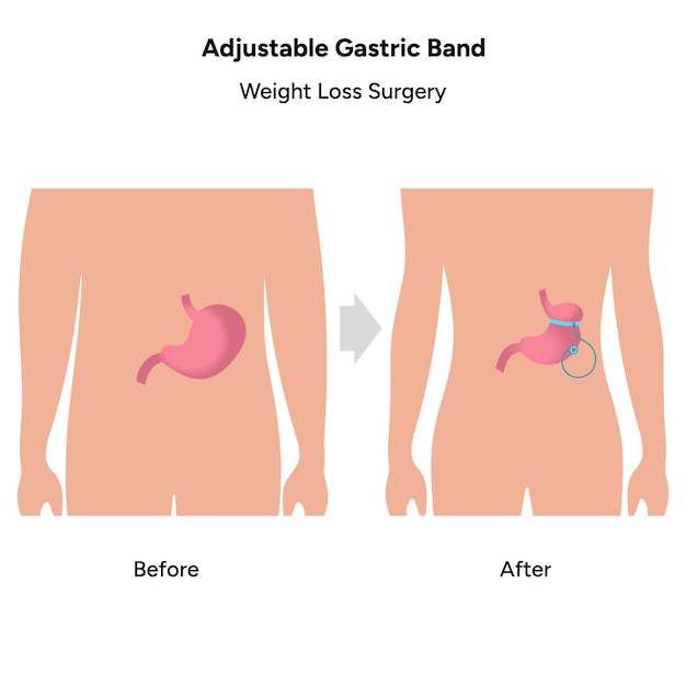 Verstelbare maagband Bariatrische chirurgische procedures