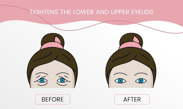 Verstevigt de lasercosmetologie van het onderste en bovenste ooglid vóór de procedure en na het aanbrengen van de behandeling Illustratie van een vrouw met en zonder rimpels