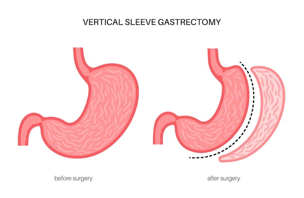 Verticale sleeve gastrectomie laparoscopie Maagchirurgie gewichtsverlies maagprocedure