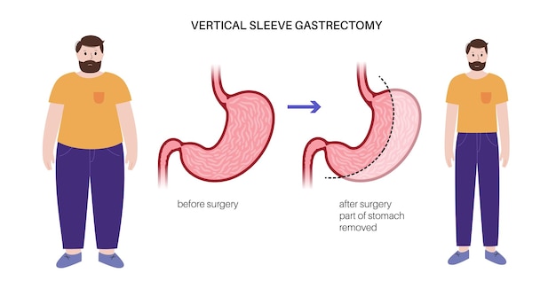 Verticale sleeve gastrectomie laparoscopie Maagchirurgie gewichtsverlies maagprocedure