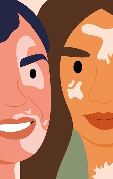 Vitiligo op het gezicht van meisjes. Platte vectorillustratie. Ansichtkaart, poster, Wereld Vitiligo Dag
