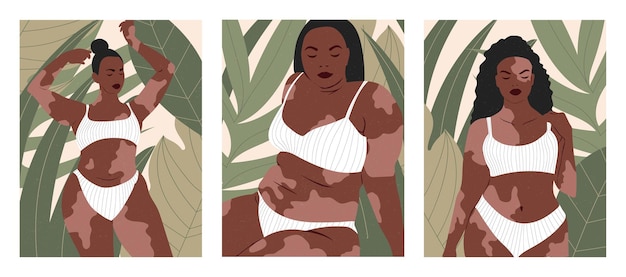 Vector vitiligo. pregnant woman with vitiligo. an african woman with pigmentation on her skin.