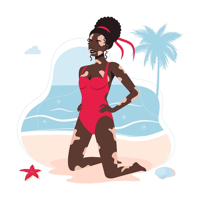 Vitiligo skin disease in African American girl in a swimsuit. woman with a diagnosis of vitiligo sunbathing on the beach is not shy. the concept of different beauty, bodily positive, self-acceptance.