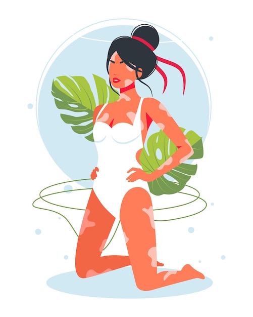 Vector vitiligo skin disease in girl in a swimsuit. woman with a diagnosis of vitiligo sunbathing on the beach is not shy. the concept of different beauty, bodily positive, self-acceptance.