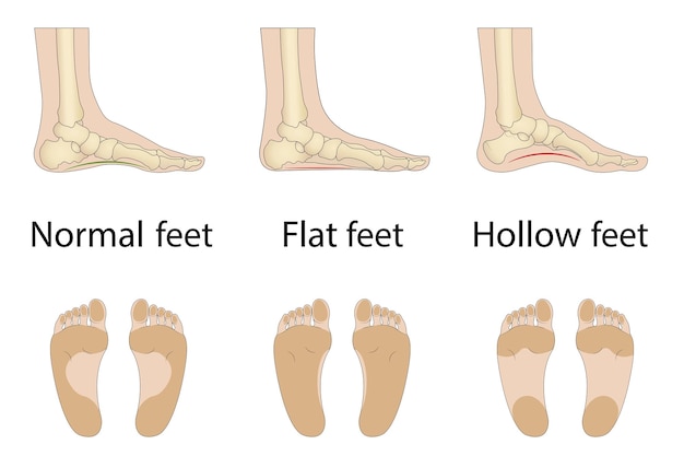 Vector voetmisvorming soorten medische ziekte infographics holle platte en normale voet vectorillustratie