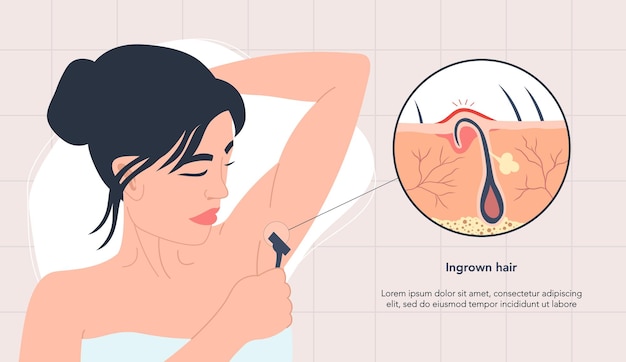 Vector vrouw met ingegroeide haarontsteking na het scheren