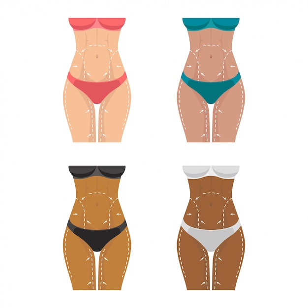 Weight loss, marks on the female body for plastic surgery.