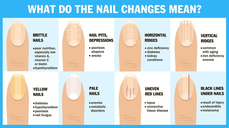 What do the nail changes mean The appearance of the nail and the associated disease Brittle nails