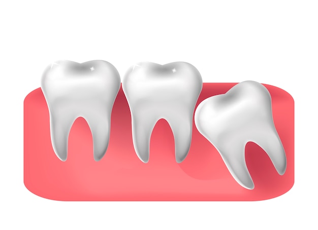 Wisdom tooth cut through,  realistic style. dentistry, wisdom teeth extraction concept.  illustration