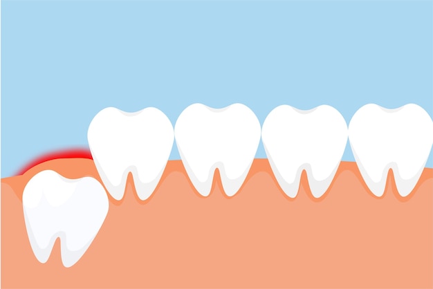 Un dente del giudizio erutta attraverso la gengiva e dà un concetto di segnale di dolore rosso il pericoloso mal di denti del giudizio provoca dolore alle gengive vettore dente che spinge dall'interno e dà dolore alla gengiva