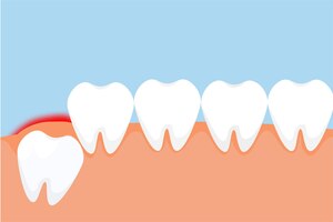 Vettore un dente del giudizio erutta attraverso la gengiva e dà un concetto di segnale di dolore rosso il pericoloso mal di denti del giudizio provoca dolore alle gengive vettore dente che spinge dall'interno e dà dolore alla gengiva