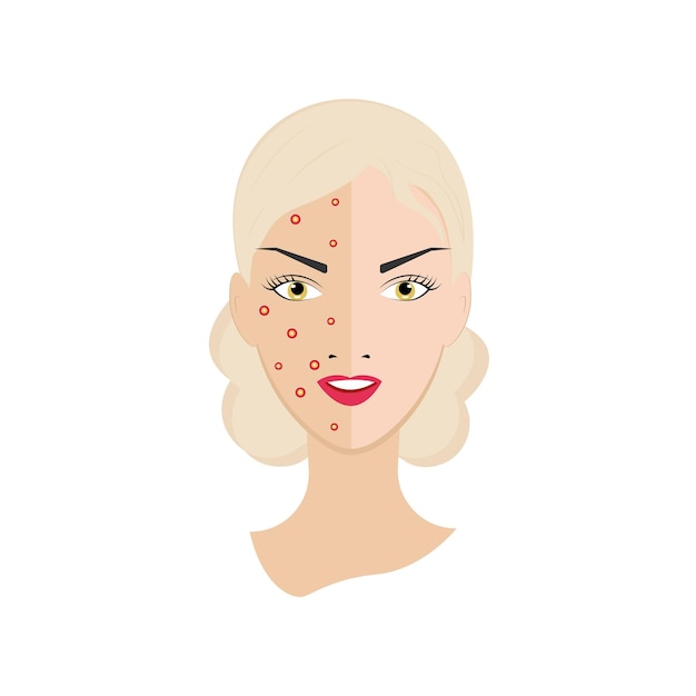 A woman with acne and healthy skin