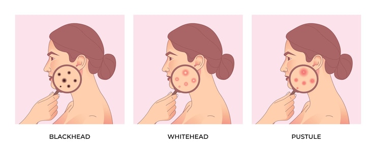 Vector women face with different types of acne, pimples, skin pores, blackhead, whitehead. acne treatment.