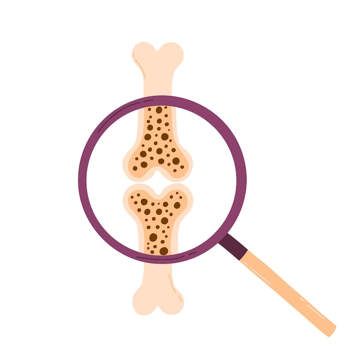 World Osteoporosis Day Poster about osteoporosis Vector illustration of porous bone Flat style