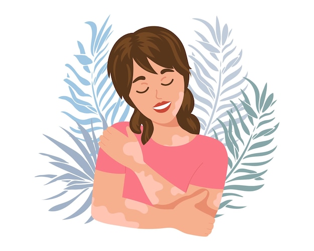 세계 백반증의 날, 인식 배너. 열 대 잎 배경에 vitiligo 질병을 가진 귀여운 여자