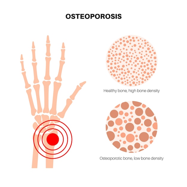 Вектор Постер остеопороза запястья системное скелетное расстройство потеря минеральной плотности костей