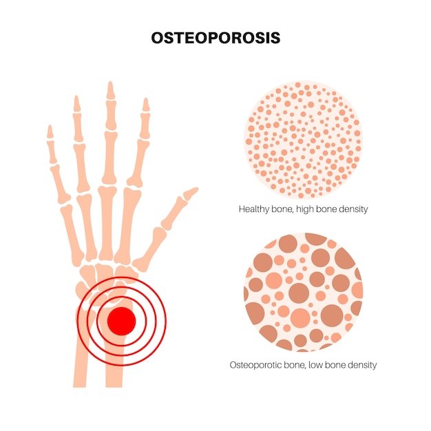 ベクトル 手首の骨粗鬆症のポスター 骨格疾患 骨のミネラル密度の減少