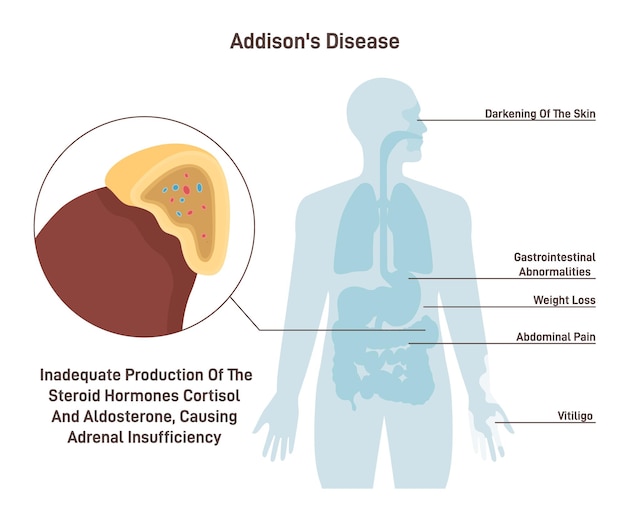 Ziekte van Addison Symptomen van chronische bijnierinsufficiëntie of hypocortisolisme