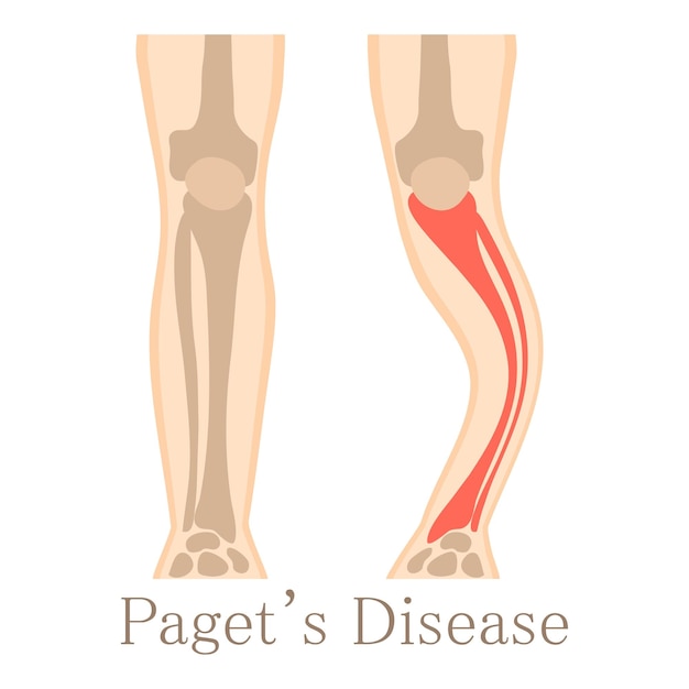 Ziekte van Paget pictogram Cartoon illustratie van de ziekte van Paget vector pictogram voor web geïsoleerd op een witte achtergrond