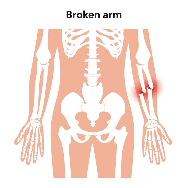 Broken arm ulna and radius