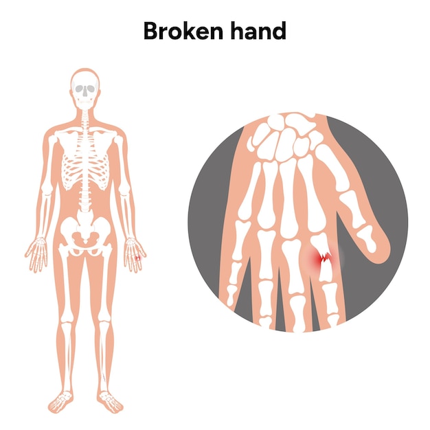 broken hand