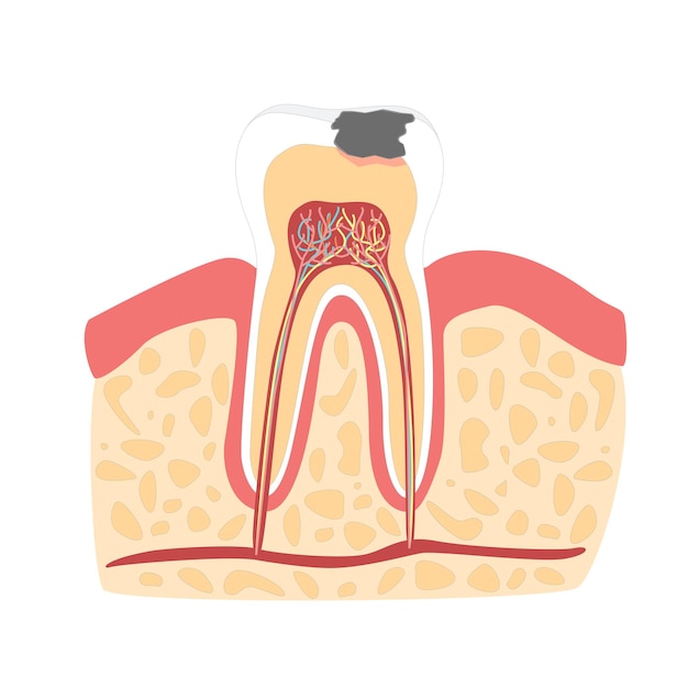 cartoon tooth with stage of dental caries formation flat design style isolated on a white background. vector illustration
