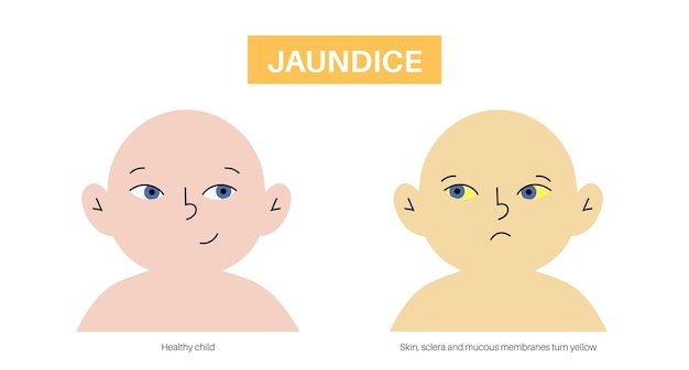Jaundice yellow skin