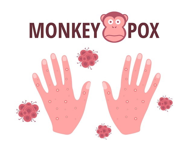 monkey pox virus vector design with skin rash on the hands symptom of an infectious disease