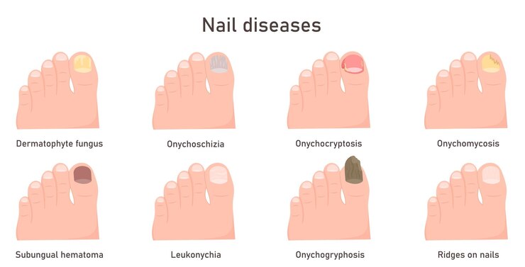 Vektör nail diseases nail fungal infection onychomycosis onycholysis problem toenail