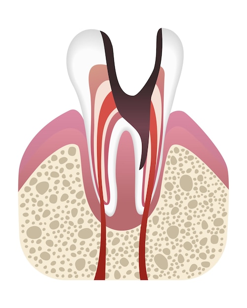 stage of caries development tooth structure in flat style tooth decay with enamel dental disease realistic vector illustration