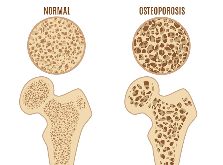 Osteoporosis Bone Infographics Concept Card Poster Medical Human Health