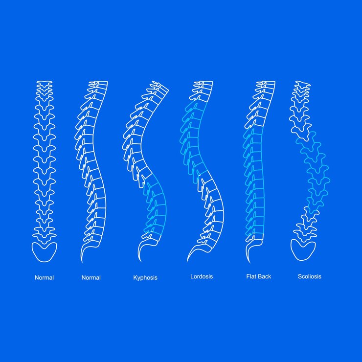 Osteoporosis Bone Types Infographics Concept Card Poster Contour Linear Style Vector