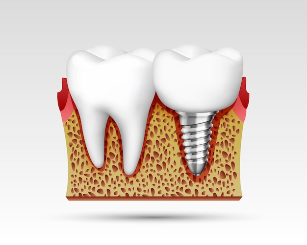 Plik wektorowy 3d zęby w rozcięciu z zakończeniami nerwowymi i implantem. ilustracja wektorowa
