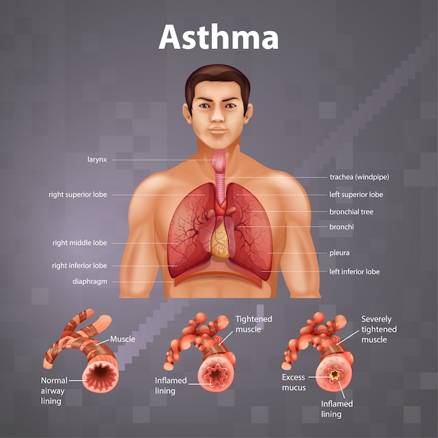 Anatomia Człowieka Schemat Astmy