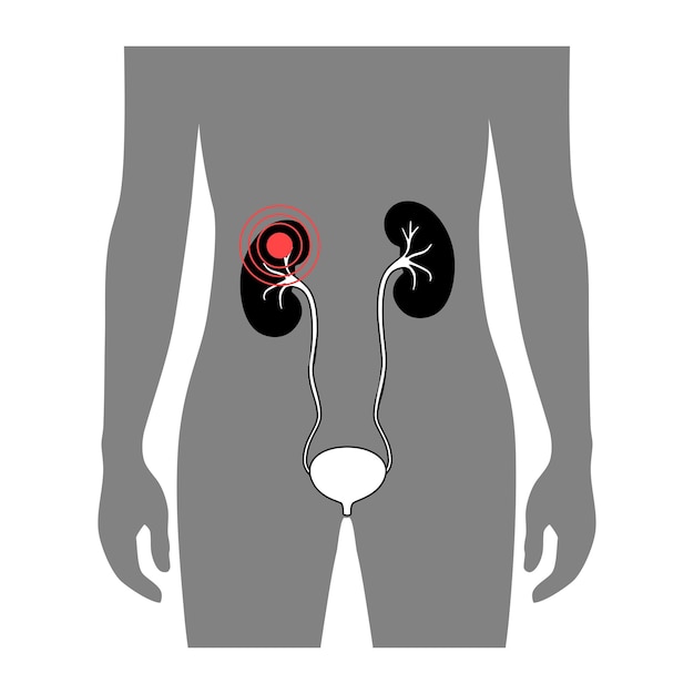 Plik wektorowy anatomia nerek w męskiej ciele medyczne płaskie wektor ilustracja na białym tle. sylwetka człowieka