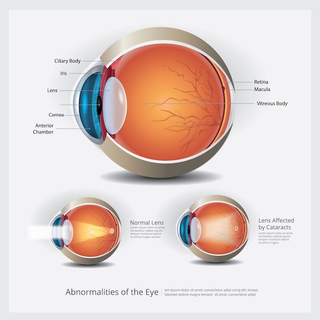 Anatomia Oka Z Nieprawidłowościami Oczu